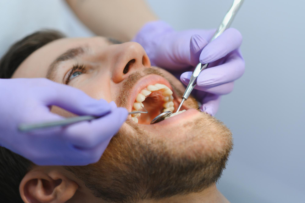 Dental Fillings
